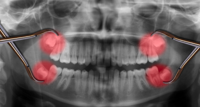 Wisdom Teeth often cause pain and discomfort in the mouth. 